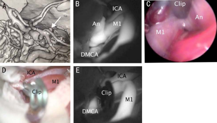 Duplicated middle cerebral artery (DMCA) aneurysm treated with endoscope-assisted microsurgery-integrated indocyanine green video-angiography.  Three-dimensional reconstruction of computed tomography shows DMC Aaneurysms (Figure 1A). Microscope-integrated indocyanine green video-angiography (mICGVA) showed the aneurysm (An), the internal carotid artery (ICA), and DMCA (Figure 1B). Intraoperative endoscope view shows the neck remnant after clipping, therefore  adjusted clip to obliterate the aneurysm completely (Figure 1C). Intraoperative microscopic view of the aneurysm sac and DMCA after clipping (Figure 1D). Microscopeintegrated indocyanine green video-angiography (mICG-VA) showed the aneurysm was clipped and the clip occluded the neck of aneurysm completely (Figure 1E)