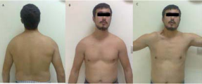 A 26-year-old man with both spinal accessory nerve and dorsal  scapular nerve palsy caused by compression of the posterior cervical triangle. A)  and B) His shoulders are asymmetrical, given the drooping of the right shoulder  girdle. C) The restricted right shoulder, showing the deepened supraclavicular  fossa on active abduction. He reported pain when abducting his right arm to  shoulder level and a decreased range of movement in the arm.