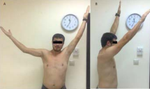 Active range of motion in his right arm was restricted to 90° in  abduction (A) and to 160° in flexion (B). (Photos used with the permission of  the patient)