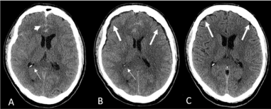  Axial non contrast head CT shows (A) subarachnoid hemorrhage (short arrow) without ventriculomegaly (thin arrow). (B) Bi-frontal extra axial fluid collections  or external hydrocephalus (thick arrows) without ventriculomegaly (thin arrow). (C) Resolved extra axial collections (thickarrows) and subarachnoid hemorrhage