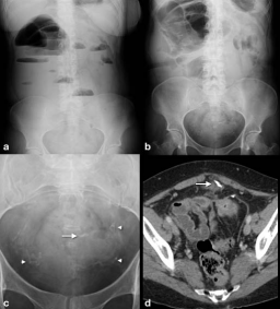 Figure 1 Plain abdominal films in upright position (a) and decubitus (b and  c) show small bowel dilatation, fluid levels, multiple vascular calcifications  (arrowheads) and a non-vascular calcification (arrow). Abdominal CT  correlation of the calcification is shown in panel d (arrow