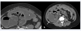 Figure 2 Contrast-enhanced abdominal CT scan showing loculated and  septated ascites(arrowhead), peritoneal thickening, small bowel tethering and  focal small-bowel dilatation (arrow).