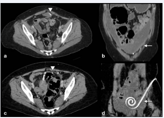 Figure 3 Axial (a and c) and coronal reformatted (b and d) abdominal CT  scans. Current CT scan (a and b) show calcification (arrowhead) and peritoneal  thickening (arrow) and loculated ascites. A three-year prior CT scan (c and d),  shows the peritoneal catheter course which correspond to the sites of thickening  (arrow) calcification (arrowhead) shown in the current abdominal CT.