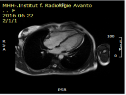 Video 1 SSFP cine imaging of 4-chamber view: non-compacted myocardium  is found in midventricular to apical parts of the left ventricle with a ratio of >  2.3:1 of non-compacted (NC) to compacted (C) myocardium in diastole. In the  right ventricle, apical displacement of about 2.5cm of the septal tricuspid leaflet  is visible with tricuspid regurgitation