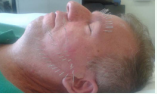 Acupuncture technique applied to the nerve branches. Source: Personal collection