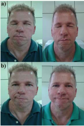 (a) Comparison of photographic images with eyes closed pre and  post acupuncture, (b) Comparison of facial expressions while smiling pre and  post acupuncture. Source: Personal collection.