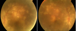  Bilateral multiple big nodular lesions that were bilateral and the  presence of perivascular choroidal lesion. It showed also papilloedema.