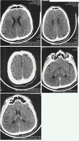  CT scan of brain was normal and did not show any cerebral or optic  nerve lesions