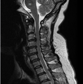 Multilevel spinal stenosis was noted in the sagittal view of the cervical spine.