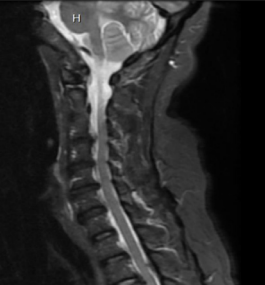 Spinal stenosis and disc disease of the cervical spine.