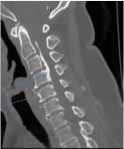 Calcification of the posterior longitudinal ligament, suggesting a diagnosis of OPLL.