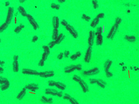 A metaphase from lymphocytes of a female patient seriously affected with exposure of Methylisocyanate gas during December 1984  exhibiting chromosomal mutagenesis as evidenced by many Sister chromatid exchanges; note the release of chromatin material from many  chromosomes (arrowed and indicated with lines). The most significant part is that chromatin may be released as dots or linear structures which get  round up to form Marker Dot or SMC. This woman died of multiple diseases including dyspnoea and cancer cervix.