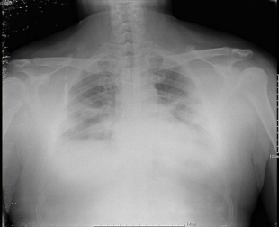 Bilateral interstitial patchy infiltrates suggestive of viral pneumonia