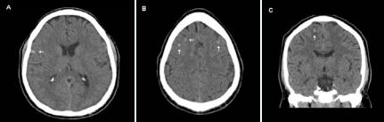 Small multi focal bilateral hemorrhages (arrows) on computed tomography (CT) scans (A, B, and C)