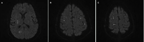  Small multi-focal bilateral ischemia (arrows) on Magnetic Resonance Imaging (MRI) scans (A, B, and C).