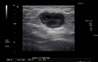Ultrasound showing left inguinal lymph node measuring  2.8x1.7x2.8 cm (2019).