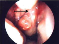  Polypoidal mass arising from sphenoethmoidal area in the right nasal  cavity