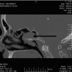 Computed tomography scan, a sagittal view of right nasal mass  arising from the sphenoid sinus.