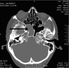Computed tomography scan, an axial view of right nasal mass arising  from the sphenoid sinus.