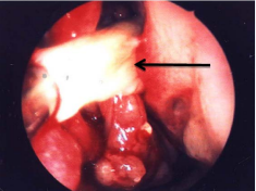  Mucopusarising from the right sphenoid sinus