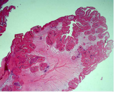  H&E x10. Inverted papilloma