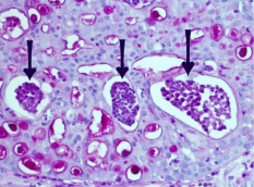  Positive PAS x 400, staining demonstrating presence of  rhinosporidium.