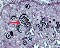  Positive Grocott’s silverx 400. Identifying sporangium with  endosporae.