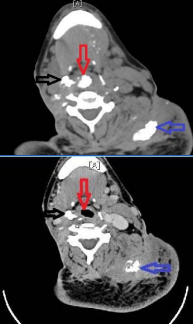  3a: Preoperative Neck CT showing right supraglottic calcified mass (open black  arrow) and airway obstruction from central supraglottic mass (open red arrow). 3b: Postoperative Neck CT showing absence of prior obstructing calcified mass  and patent airway (open red arrow). There is slight reduction in size of right  supraglottic mass (open black arrow). Preexisting calcified mass of left shoulder  is seen in both images (open blue arrow).