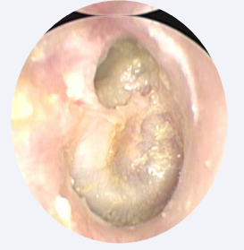  Illustration of a posterior epitympanic cholesteatoma.