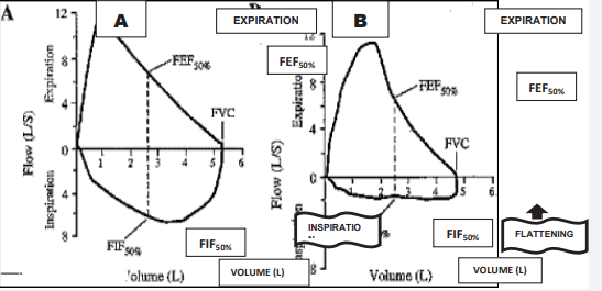 shows an example of a flow-volume loop in a normal subject (A) and in a patient with VCD (B). Note the blunting and flattening of the  inspiratory loop of the flow-volume curve (arrow). Sometimes, there is a saw-tooth inspiratory flow pattern (6); the latter is not shown in the  figure. The ratio of the spirometric forced inspiratory flow at 50% of the forced vital capacity (FIF50) divided by the maximal forced expiratory flow  at 50% of forced vital capacity (FEF50) is reduced
