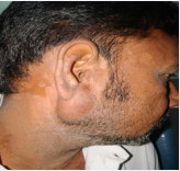  Patient presented to us with a Right Parotid Region Swelling.