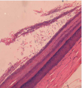  Post-operative Histopathology picture of the cyst.
