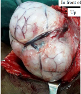  Intra-operative view: aspect of mass