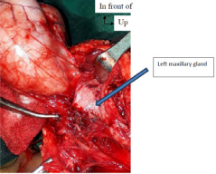  Intraoperative view: masse extending under the mind with a normallooking, maxillary gland in place.