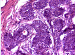  Histological aspect of sialoblastoma (Gx100, HE coloration