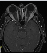  18FDG PET/CT scan. High FDG uptake of bilateral orbital muscles.
