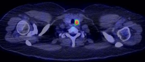 18FDG PET/CT scan. Focal FDG uptake of the left thyroid gland