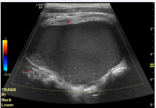  Soft tissue ultrasound of the neck revealed a cystic appearing mass