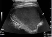  Measurements of the cystic mass on transverse view