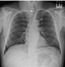  A chest X-ray showed tracheal deviation (arrow) due to the large neck  mass.