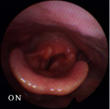 Direct fiberoptic laryngoscopy showed decreased right vocal cord  mobility compared to the left.