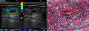 A) [TI-RADS 5 Nodule: solid, ill defined margins, marked hypo echoic,  in homogenous, and increased strain color map 4 (B): [UGFNA of malignant  nodule with abundant atypical follicular cells, with nuclear chromatin clearing,  molding, grooves and pseudo inclusions. (PAP stain 200x)].