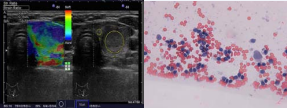  (A) TI-RADS 4B nodule: solid, oval, normal shape, good margins,  hypoechoic, no calcification, and homogenous, increased strain, color map 3 (B) UGFNA of malignant nodule showing nuclear features suggestive of PTC and  incomplete micro follicular and trabecular architecture, Bethesda IV/V (PAP  stain 200x)