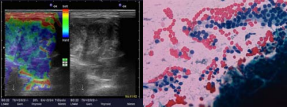  (A) TI-RADS 5 nodule: irregular shape, irregular margins, in  homogenous, disruption of the thyroid capsule, increased strain, color map 4 (B) UGFNA - suspicious of a follicular neoplasm showing a cellular aspirate  composed of crowded 3dimensional clusters of follicular cells with complete  and incomplete micro follicles. BETHESDA III (Pap stain 200x)