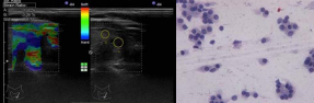 (A) [TI-RADS 4C lesion: small oval shape, intense hypoechoic, in  homogenous, irregular margins, no calcification, and increased strain, color map  5 (B) UGFNA showing a cellular aspirate composed predominately of complete  and incomplete micro follicles with slightly atypical nuclei and partial Hurthlle  cell morphology. The smear was reported Bethesda IV but proved to be FTC on  the pathological exam.