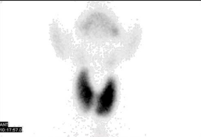  Graves’ disease. Scintigraphy demonstrates that the thyroid is  enlarged. Activity throughout the gland is increased relative to the background  due to both increased stimulation and function of the gland. The TSH was  suppressed at the time.