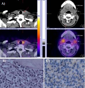  M/29year-old with high level of calcitonin – 519pg/ml. SPECT-CT with 99mTc-Tektrotyd was positive for intensive tracer uptake in the tumor formation with  mixed solid/cystic structure on the left thyroid lobe with 1 enlarged laterocervical lymph node on the left (A).  Standard H&E histological and immunohistochemical examinations positive for Calcitonin, performed after surgery, confirmed medullary thyroid cancer, x20 (B,C).