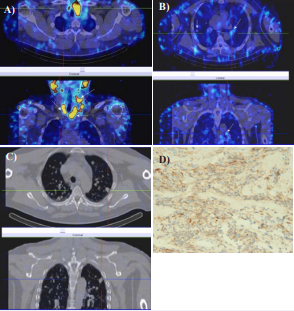 F/37year-old with high level of calcitonin -874 pg/ml. SPECT-CT with 99mTc-Tektrotyd was positive for intensive tracer uptake in  the tumor formation of the left thyroid lobe, infiltrated surrounding tissues with laterocervical, supraclavicular and hilar lymphadenopathy (A).  SPECT-CT showed a lot of metastatic small miliary lesions in the both lungs without uptake (B,C). Immunohistochemistry confirmed medullary thyroid cancer, positive after surgery for Calcitonin, x20 (D).