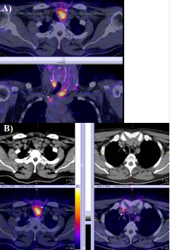  M/60 year-old with MTC after parcial thyroidectomy, cervical lymph node dissection– pT4pN2M0 and increased calcitonin level – 2012pg/ml. SPECT-CT with  99mTc-Tektrotyd showed tumor persistence in the region of the left thyroid lobe, trachea deviation to the right and enlarged laterocervical and bilateral supraclavicular  lymph nodes with high tracer uptake (A,B).