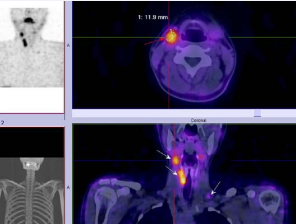  /54 year-old with MTC after total thyroidectomy with inceased calcitonin level – 94pg/ml. SPECT-CT with 99mTc-Tektrotyd showed local paratracheal recurrence  in the thyroid bed and 1 enlarged laterocervical lymph node on the right and 1 supraclavicular lymph nodes on the left with high tracer uptake (A).